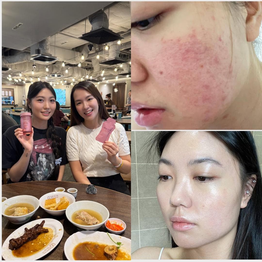 Victoria — before and after using Femoire